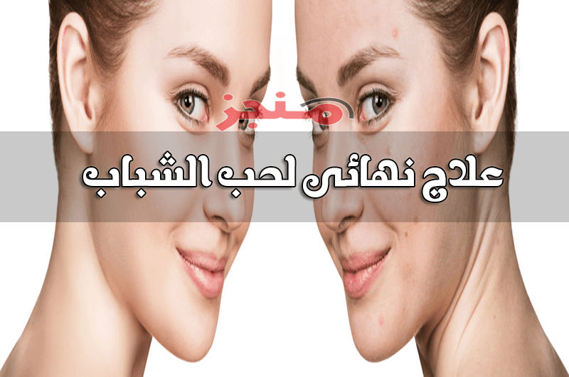حب الشباب بزيت الخروع